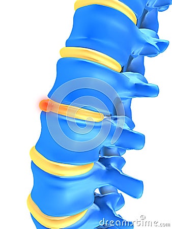 Slipped disc Cartoon Illustration