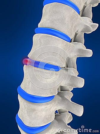 Slipped disc Cartoon Illustration