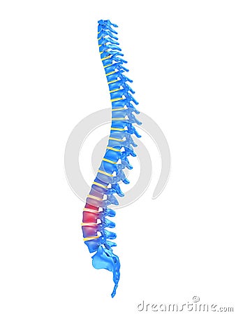 Slipped disc Cartoon Illustration