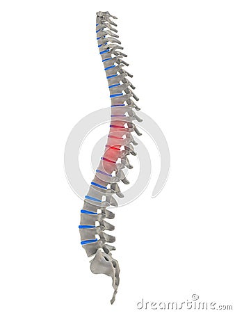 Slipped disc Cartoon Illustration