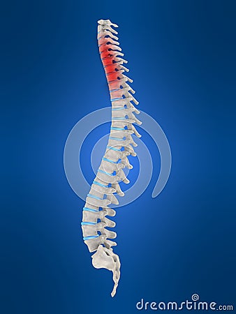 Slipped disc Cartoon Illustration