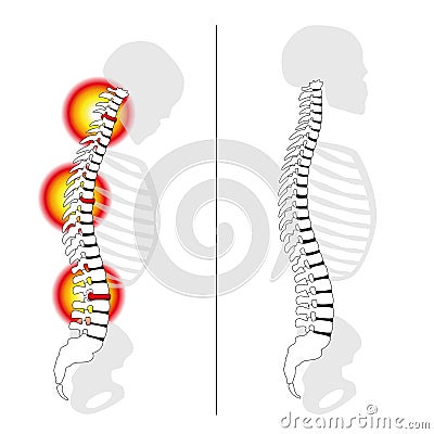 Slipped Disc Prolapse Back Pain Spine Vector Illustration