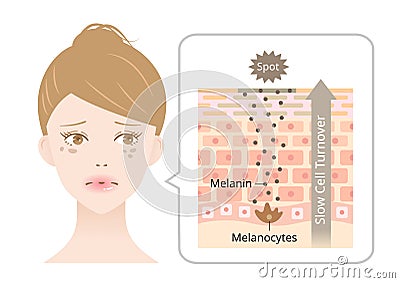 skin cell turnover and dark spots on young womanâ€™s face. melanin and melanocytes in human skin layer. Beauty and skin care Stock Photo
