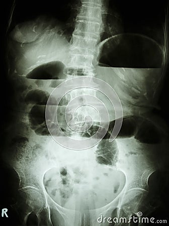 Small bowel obstruction Stock Photo