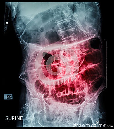 Small bowel obstruction ( film x-ray abdomen ( supine position ) : show small bowel and stomach dilate ) ( step ladder pattern ) Stock Photo