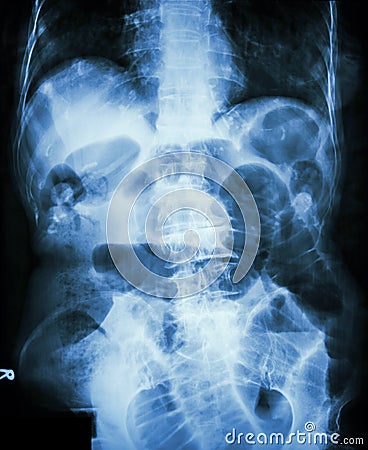 Small bowel obstruction. Film X-ray abdomen supine Stock Photo