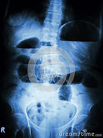 Small bowel obstruction Stock Photo