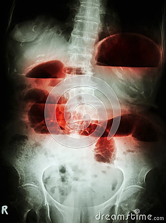 Small bowel obstruction Stock Photo