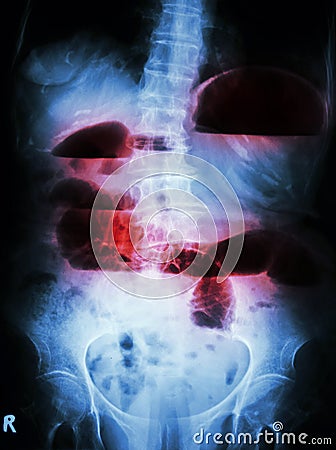 Small bowel obstruction Stock Photo