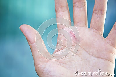 Small cut scar on girl hand Stock Photo