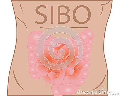 Small Intestinal Bacterial Overgrowth - SIBO Vector Illustration