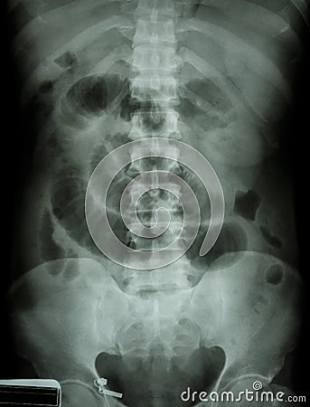 Small intestine obstruction Stock Photo