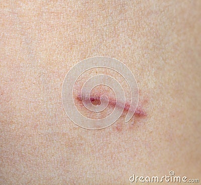 Scar on skin with body Stock Photo