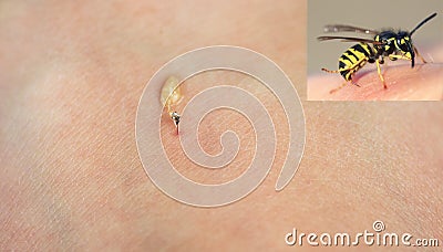 Small striped dangerous insect wasp stung a man in the skin and left its sting with poison Stock Photo