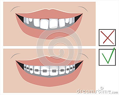 A smile with crooked teeth and with metal braces before and after the dental clinic, a vector stock illustration with molars as a Vector Illustration