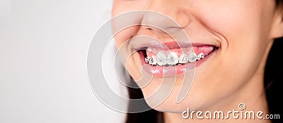 Smile of a teen girl with metal braces Stock Photo