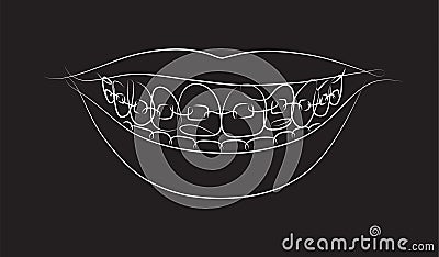 Smile with teeth braces black color Vector Illustration