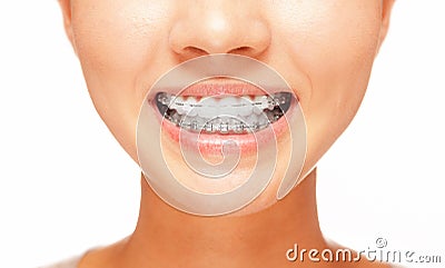 Smile: teeth with braces Stock Photo