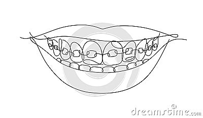 Smile with teeth braces flat line white color Vector Illustration