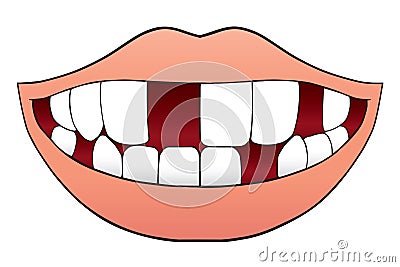 Mouth With Missing Teeth Vector Illustration