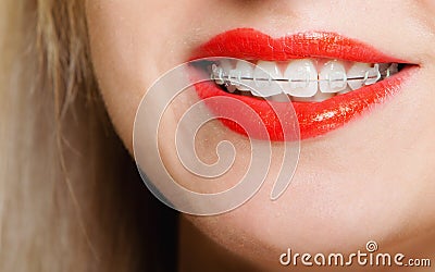 Smiling girl with braces face part teeth straighten, tooth hygiene Stock Photo