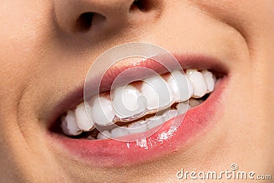 Smiling girl wearing invisible teeth braces Stock Photo