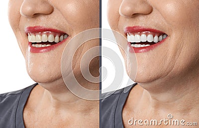 Smiling mature woman before and after teeth whitening procedure Stock Photo