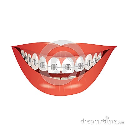 Smiling mouth with braces Vector Illustration