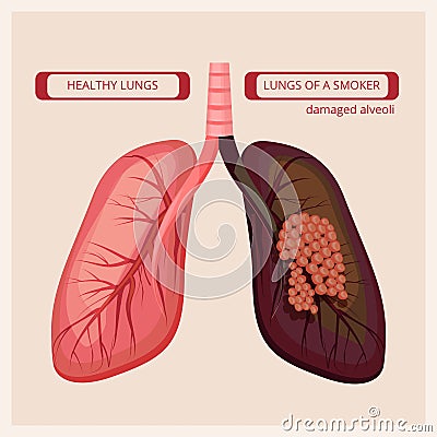 Smoker lungs. Smoke human damage lung cancer vector medical infographic pictures Vector Illustration