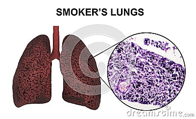 Smoker`s lungs, medical concept Cartoon Illustration