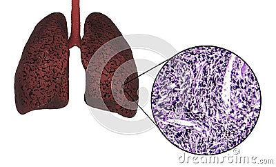 Smoker`s lungs, medical concept Cartoon Illustration
