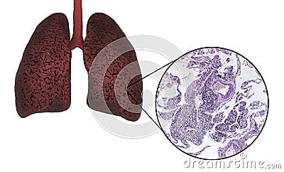 Smoker`s lungs, medical concept Cartoon Illustration