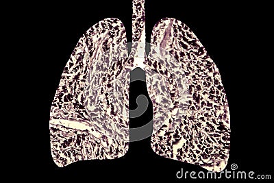 Smoker`s lungs, medical concept, 3D illustration, Lung disease conceptual image Cartoon Illustration