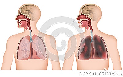 Smoking lung medical illustration on white background , man with cigerette Cartoon Illustration