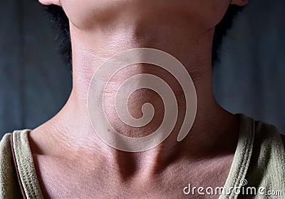 Smooth, diffuse thyroid swelling of Southeast Asian, Burmese young man. A goiter can occur with hypothyroidism or hyperthyroidism. Stock Photo