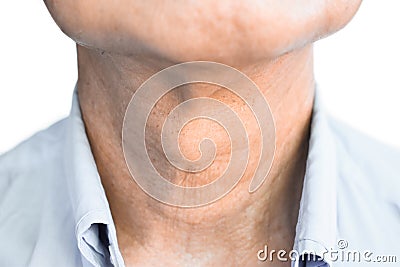 Smooth, diffuse thyroid swelling of Southeast Asian, Myanmar or Burmese young man. A goiter can occur with hypothyroidism or Stock Photo