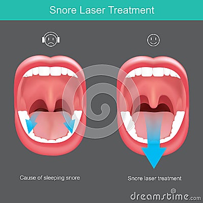 Snore Laser Treatment. Vector Illustration