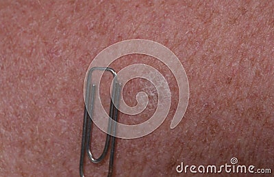Actinic keratosis on human skin Stock Photo