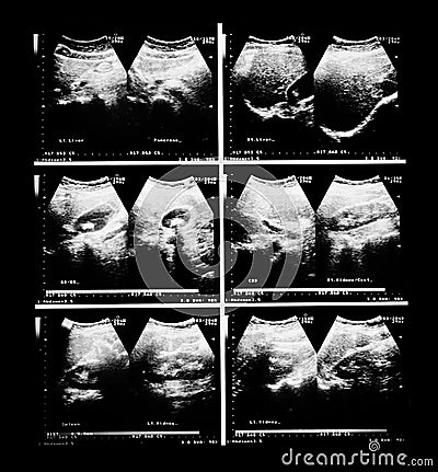 Sonography upper abdomen medical examination. Stock Photo