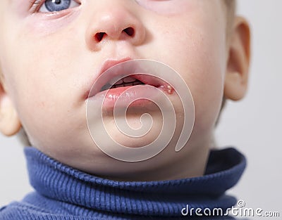 sore on the lip of the child herpes Stock Photo