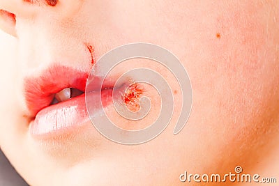 sore on the lip of the child herpes Stock Photo