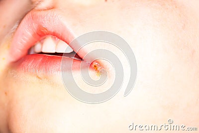 Sore on the lip of the child herpes Stock Photo