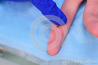 Sore of removed wart after laser removal on patient finger, closeup view. Stock Photo
