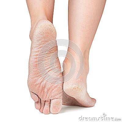 Sore skin of feet, crack, dry heels Stock Photo