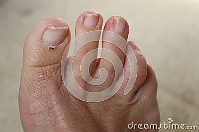 Sore skin on feet dry dehydrated feet of a lady ,five toes with clean skin Stock Photo