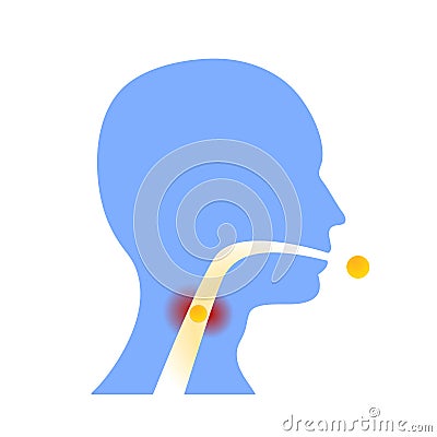 Sore throat inflammation remedy Vector Illustration