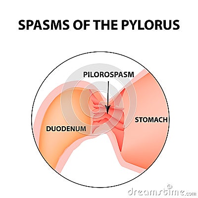 Spasms of the pylorus. Pylorospasm. Spastic and atonic. Pyloric sphincter of the stomach. Infographics. Vector image Vector Illustration