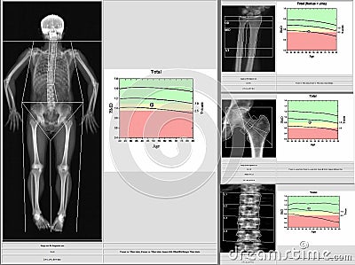 Special exam results bone density.too blurriness and artifacting image Stock Photo