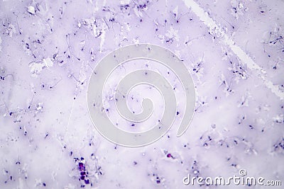 Sperm morphology. Semen photo under microscope Stock Photo