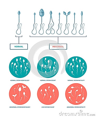 Spermogram. Medical infographic with healthy and damaged spermatozoa birth plan ovulation processes garish vector flat Vector Illustration